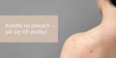 Pryszcze na plecach: Jak się ich pozbyć? Poradnik eksperta
