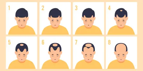 Illustration montrant les 8 stades de la calvitie héréditaire, de la chevelure complète à la calvitie totale.