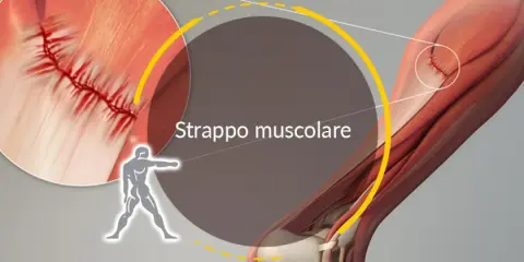 Illustrazione anatomica di uno strappo muscolare, con ingrandimento che mostra la sutura di una lesione muscolare.