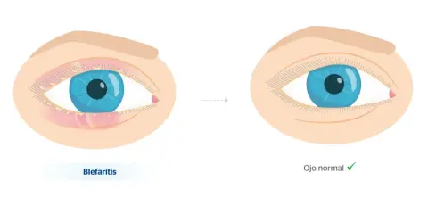 Ojo con blefaritis, inflamado y con secreción, evoluciona a un ojo normal.