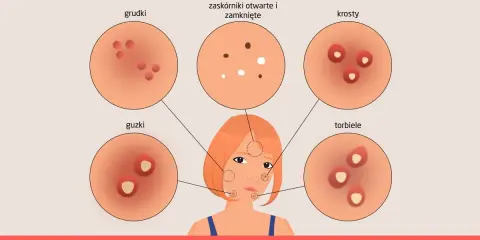 Ilustracja pokazuje, jak wygląda trądzik: grudki, krosty, guzki, torbiele i zaskórniki.