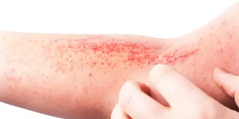 Braccio con eruzione cutanea rossa e pruriginosa, tipica della dermatite atopica. Le dita grattano la pelle irritata.