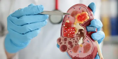 Lekarz w niebieskich rękawiczkach wskazuje na model nerki z guzem, omawiając rirs zabieg.