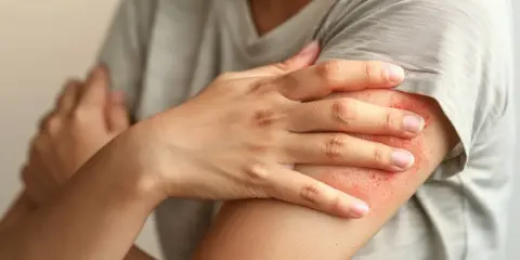 Ręka z zaczerwienioną, swędzącą wysypką. Szukamy skutecznego pokrzywka leczenie domowe.