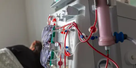 Dializa to często długotrwałe leczenie, ale nie zawsze jest do końca życia. Maszyna do dializy z czerwonymi i przezroczystymi przewodami.