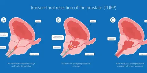 Ilustracja pokazuje przebieg resekcji przezcewkowej prostaty (TURP). Po zabiegu rekonwalescencja po operacji prostaty TURP pozwala na powrót do normalnego oddawania moczu.
