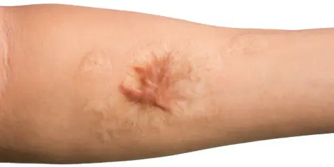 Gros plan sur un bras humain montrant une cicatrice hypertrophique, surélevée et rosée, témoignant d'une guérison cutanée complexe.