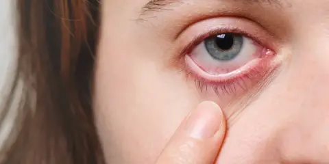 Ein blasses Unterlid und gerötete Augen können Anzeichen von Blutarmut im Alter sein.