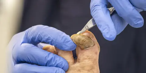Podolog delikatnie usuwa zrogowaciałe, przypominające krogulcze paznokcie, używając specjalistycznego narzędzia.