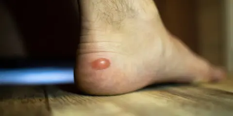 Une phlyctène sur le talon, que faire ? Cette ampoule rouge sur la peau du pied est douloureuse.