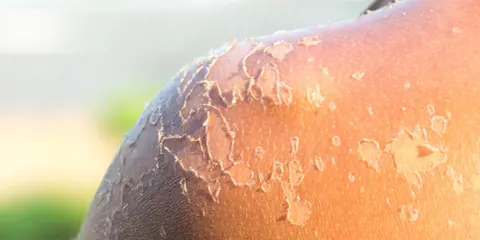 Peau qui pèle après un coup de soleil. La guérison peut prendre plusieurs jours, voire une semaine.
