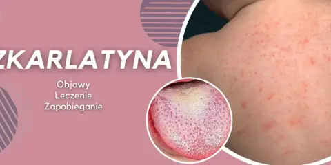 Szkarlatyna: czerwona wysypka na skórze i malinowy język. Objawy, leczenie i zapobieganie. Podobne do rumienia zakaźnego, ale wymaga innej diagnostyki.