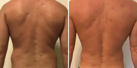 Risultati visibili di liposuzione schiena prima e dopo: la schiena appare più definita e liscia, con una riduzione del grasso accumulato.