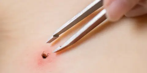 Kawałek kleszcza w skórze? Spokój i instrukcja: weterynarz czy obserwacja?