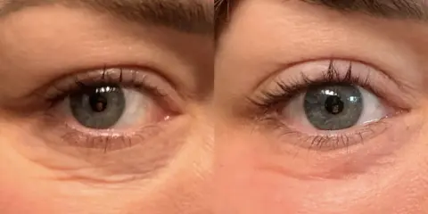 Occhi prima e dopo peeling TCA: rughe attenuate e pelle più liscia.