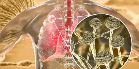Ingrandimento di Aspergillus fumigatus che infetta i polmoni umani.