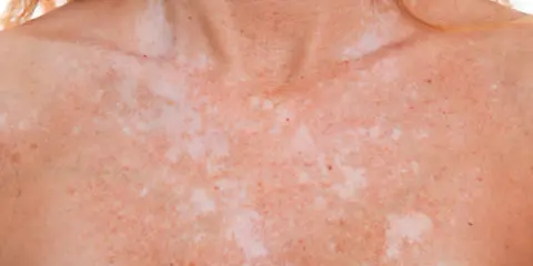 Poitrine et cou d'une personne présentant une dépigmentation de la peau, avec des taches claires et foncées.