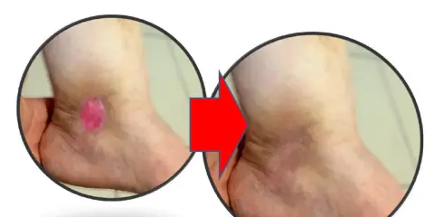 Prima e dopo: ulcere alle gambe che perdono acqua, ora in guarigione.