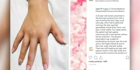 Dłoń z widocznymi krostami, jeden z objawów rzeżączki.