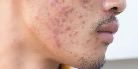 Gros plan sur le visage d'un homme présentant une acné sévère, avec des rougeurs et des pustules visibles sur la joue et le menton.