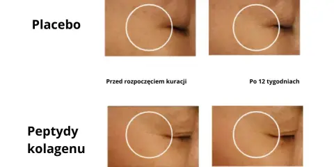 Porównanie efektów kolagenu do picia: skóra przed i po 12 tygodniach kuracji. Zmniejszenie zmarszczek wokół oka.