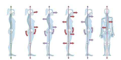 Illustration zeigt verschiedene Körperhaltungen: neutrale, Lordose, Kyphose, flacher Rücken, Hohlkreuz und Skoliose. Schlechte haltung wird durch rote Kreuze markiert.