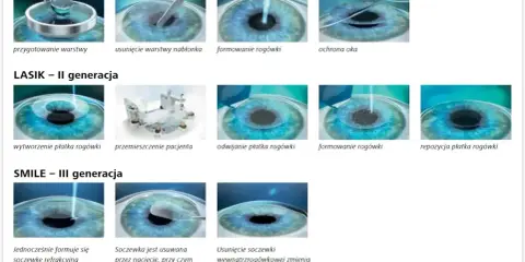 Ilustracje pokazują etapy leczenia astygmatyzmu metodami PRK, LASIK i SMILE.