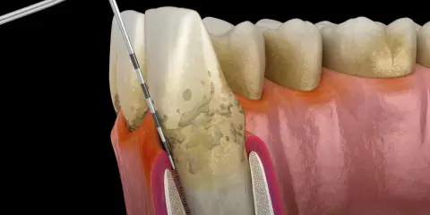 Model szczęki z widocznym zapaleniem kieszonki dziąsłowej. Narzędzie dentystyczne usuwa kamień nazębny spod linii dziąseł.
