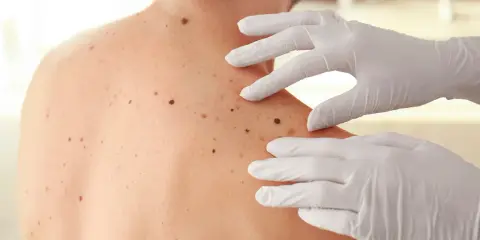 Mani guantate esaminano la schiena di una persona, dove mi stanno spuntando molti nei.