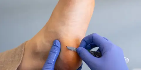 Un podologue enlève une callosité au pied avec un scalpel.