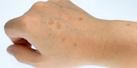 Gros plan sur le dos d'une main montrant plusieurs taches brunes sur la peau, signes du temps ou du soleil.