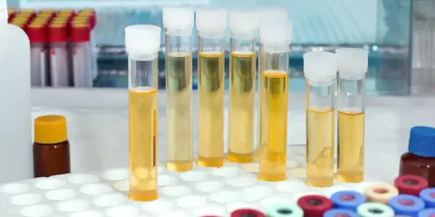 W probówkach laboratoryjnych widać żółtawy płyn, który może wskazywać na mętny mocz.