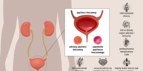 Ilustracja przedstawia objawy zapalenia dróg moczowych: ból, pieczenie, nietrzymanie moczu, gorączkę, ból brzucha i pleców, mętny mocz.