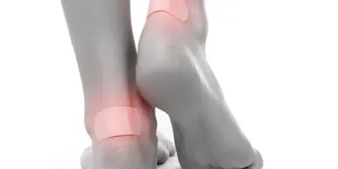 Pieds avec pansements sur les talons pour soulager une phlyctène douloureuse.