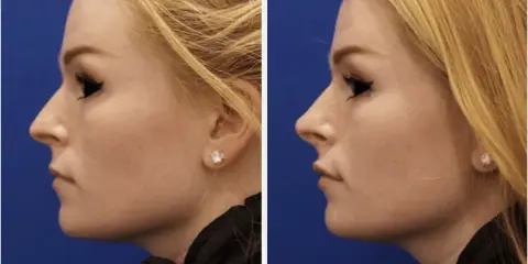 Profilo di donna prima e dopo rinofiller naso frontale. Il trattamento ha migliorato la linea del naso e del mento.