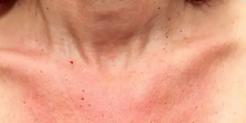 Peau rougie et tachetée sur le cou et le décolleté, comme un visage qui aurait pris un coup de soleil.