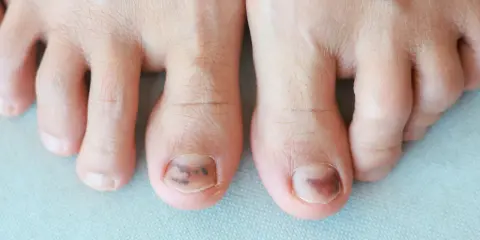 Gros plan sur des orteils, dont deux présentent une plaque de l'ongle abîmée avec des ecchymoses sombres, suggérant un traumatisme.