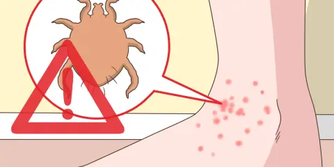 Un pied présente des piqûres rouges, signe d'un orteil qui gratte le soir à cause d'un acarien.