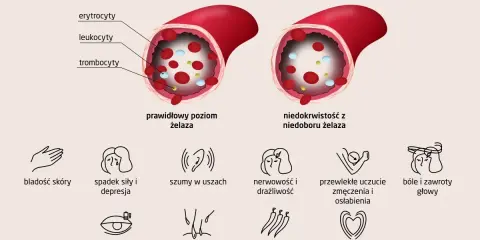 Niski poziom żelaza prowadzi do niedokrwistości, objawiającej się bladością skóry, zmęczeniem, szumami w uszach i bólami głowy.