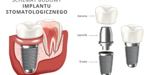 Schemat budowy implantu stomatologicznego. Dowiedz się, ile kosztuje wstawienie zęba i jak wygląda jego konstrukcja: śruba, łącznik i korona.
