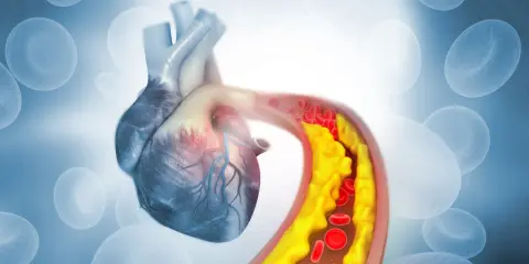 Serce z widocznym zatorami w naczyniach krwionośnych spowodowanymi przez zły cholesterol.