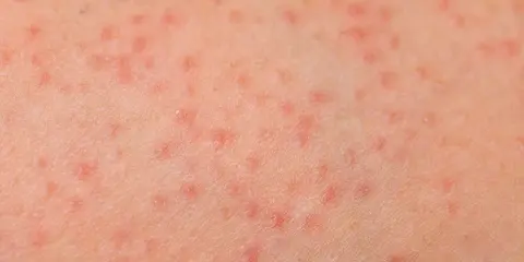 Pelle con prurito alle gambe, caratterizzata da numerosi puntini rossi che indicano un'irritazione cutanea.