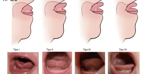 Ilustraciones y fotos muestran los tipos de anquiloglosia que es la limitación del movimiento de la lengua.