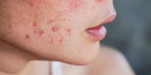 Gros plan sur une joue présentant des rougeurs et des papules, symptômes de la rosacée papulo-pustuleuse.