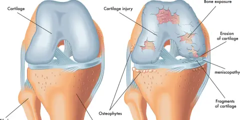 Vergleich eines gesunden Knies mit Arthrose. Arthrose zeigt Knorpelschäden, Knochenexposition und Osteophyten, was zu steifen Gelenken führt.