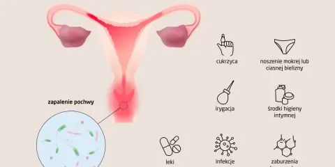 Ilustracja przedstawia przyczyny zapalenia pochwy, w tym infekcje intymne, cukrzycę i zaburzenia hormonalne.