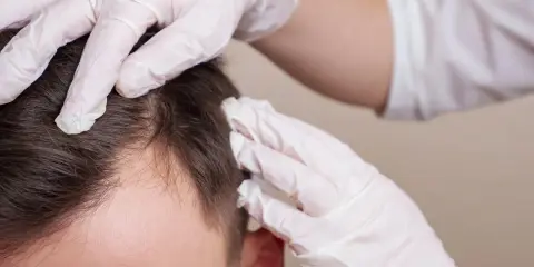 Hände in weißen Handschuhen untersuchen die Kopfhaut eines Mannes, um Haarausfall zu verhindern.