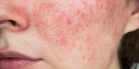 Gros plan sur une peau rougie avec des rougeurs et des petites papules sur le visage, près du nez et de la bouche.
