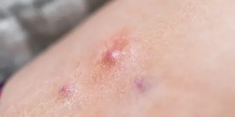 Pelle con arrossamento e piccole vescicole, indicative di dermatite bollosa.