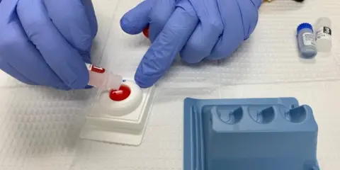 Manos enguantadas realizan prueba rápida para diagnóstico y tratamiento de gonorrea.